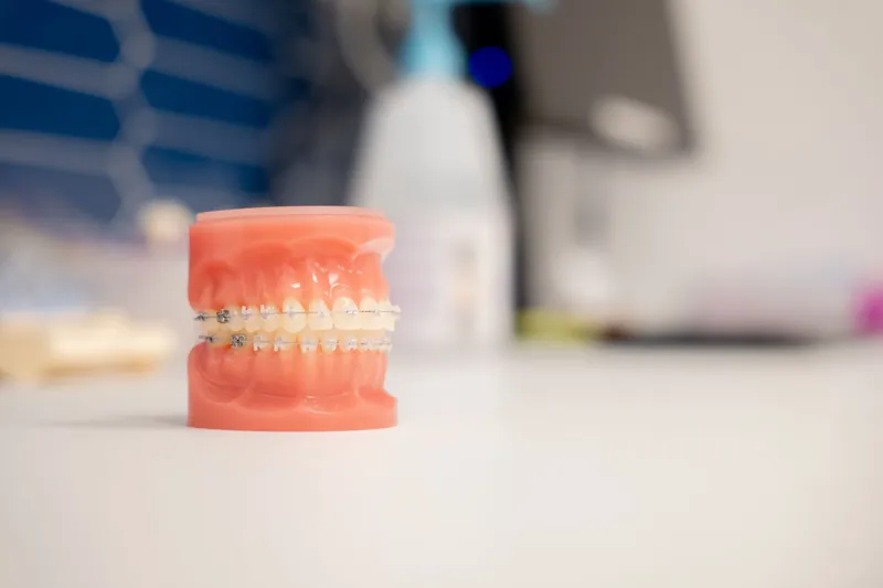 Modèle dentaire avec bagues orthodontiques en céramique, Médipôle de Schiltigheim